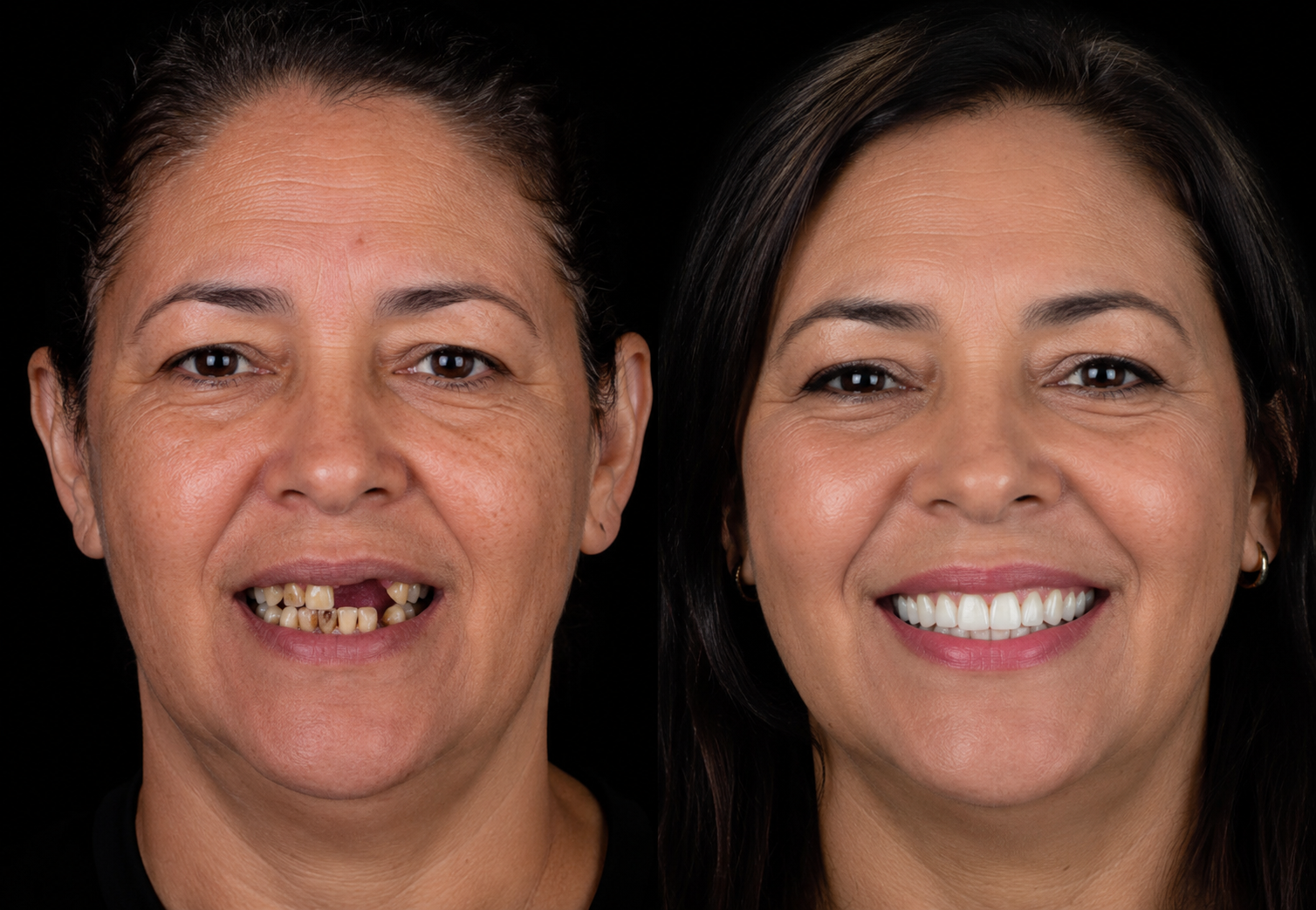 Antes e depois de paciente reabilitado com implantes dentários e prótese protocolo em Uberlândia